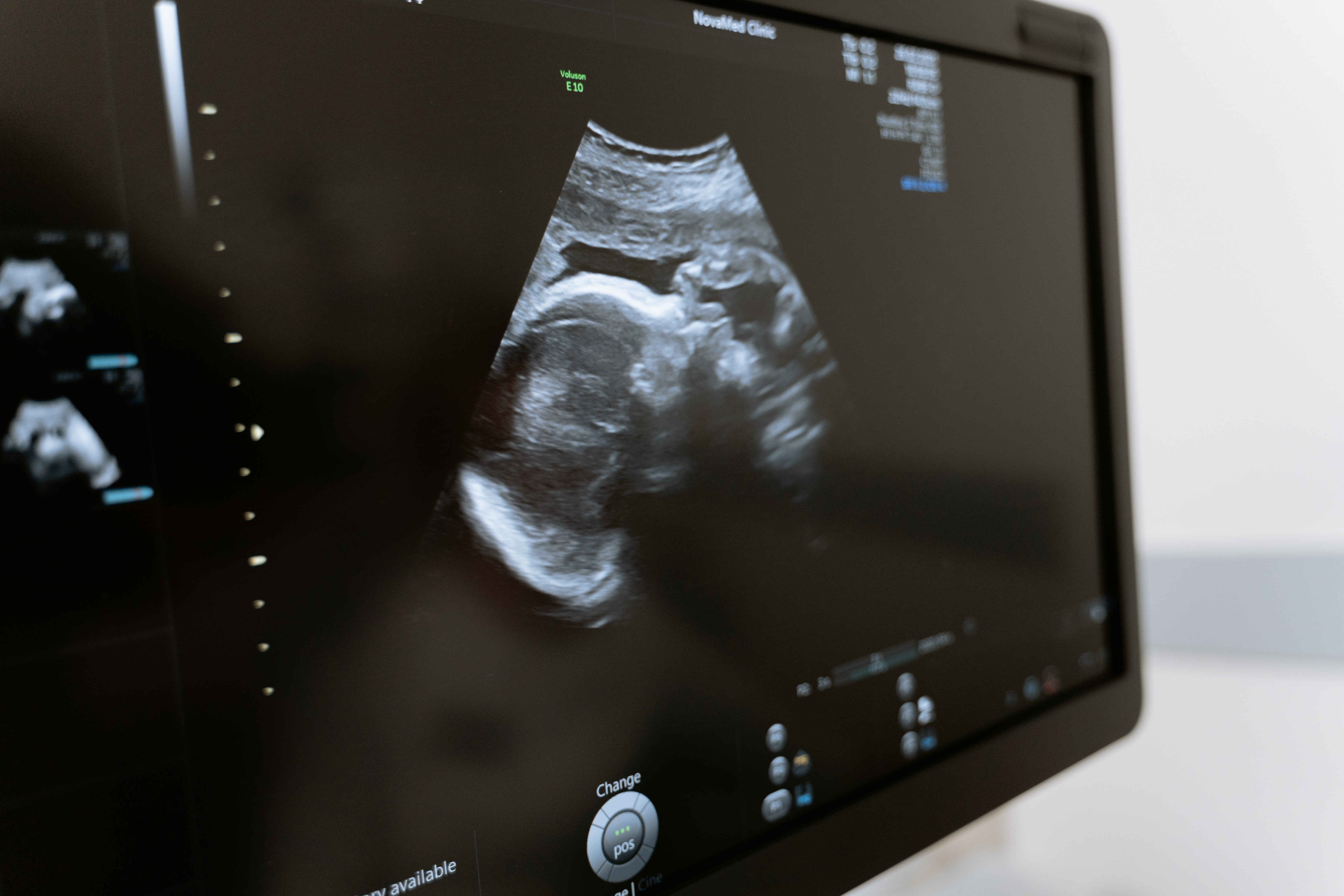 An image of an ultrasound; the quality of these images could be improved with this new technology. 